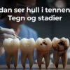 Professional header image for educational tutorial: Hvordan ser hull i tennene ut? Tegn og stadier